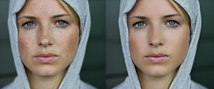 磨皮手術效果圖 (47) 