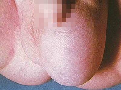 小兒鞘膜積液 (9) 