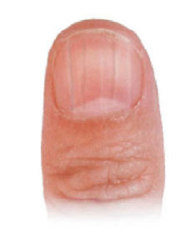 手指甲上有豎紋圖解 (45) 