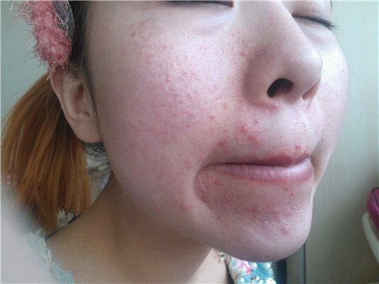 血熱的症狀痘痘