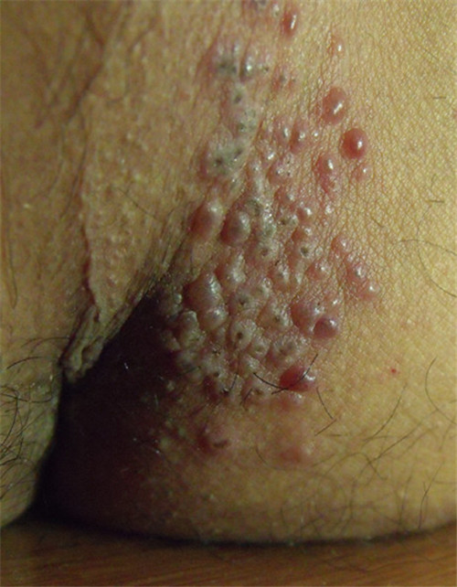 苔蘚狀假性溼疣女性