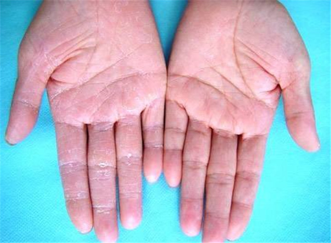 傳染性軟疣治療 