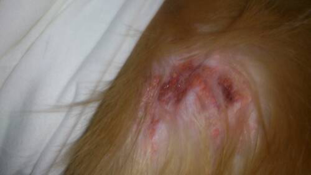 皮膚黃色瘤病中期