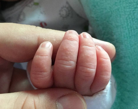 寶寶手上長水泡