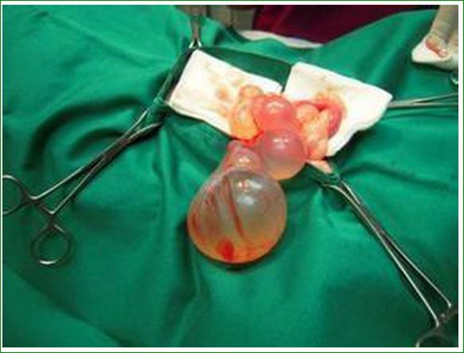 輸卵管巧克力囊腫排出