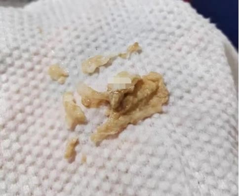 黴菌陰炎症狀 (41) 