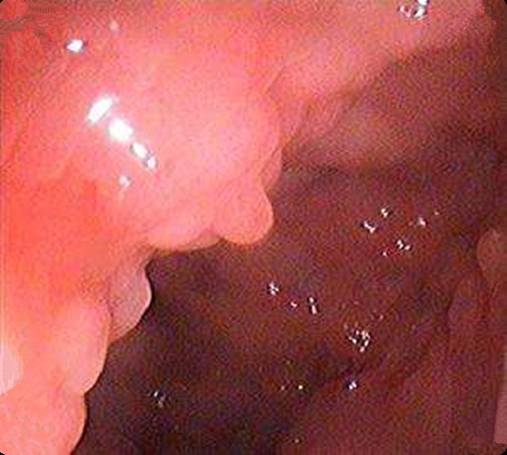 早期慢性結腸炎的