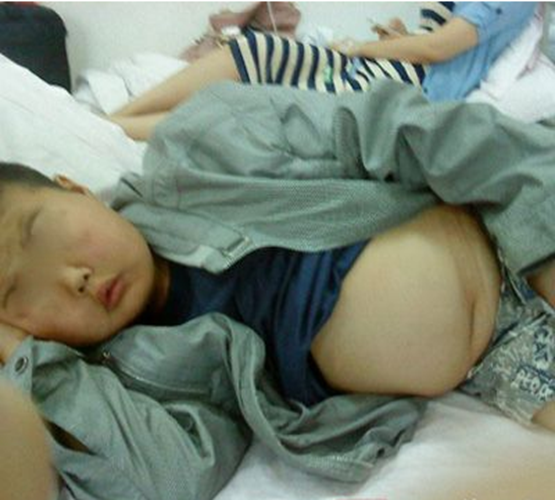 小孩患糖尿病腎病