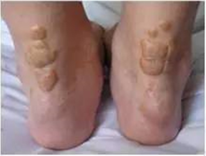 足部黃色瘤病