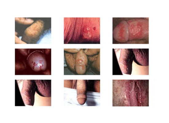 尿道口紅腫 (44) 