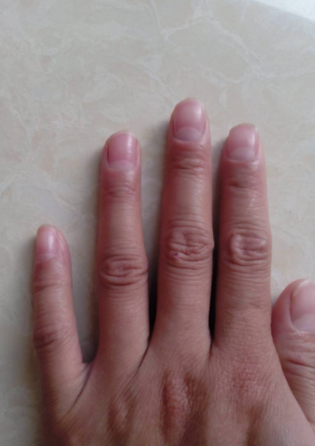 貧血指甲