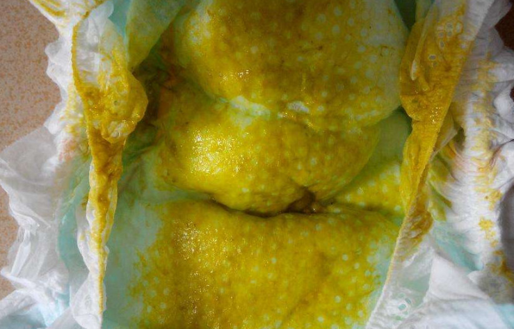 新生兒腹瀉大便