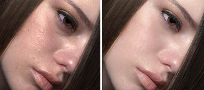 磨皮手術效果圖 (48) 