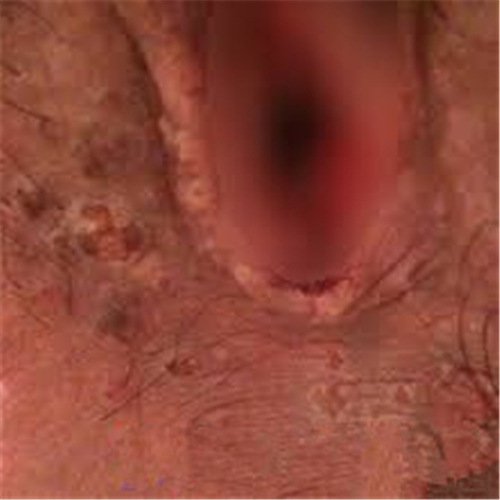 過敏性外陰瘙癢