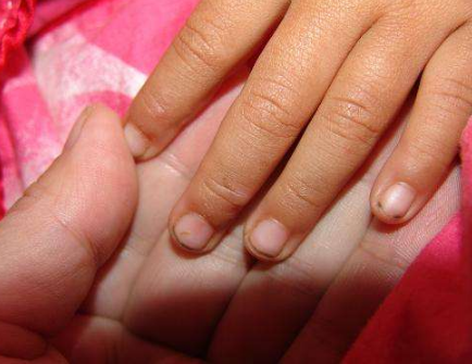 寶寶手上長水泡