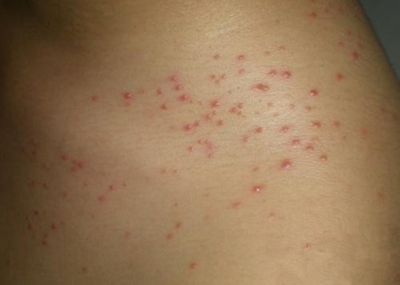 藥物性皮炎紅色疙瘩腰部局部