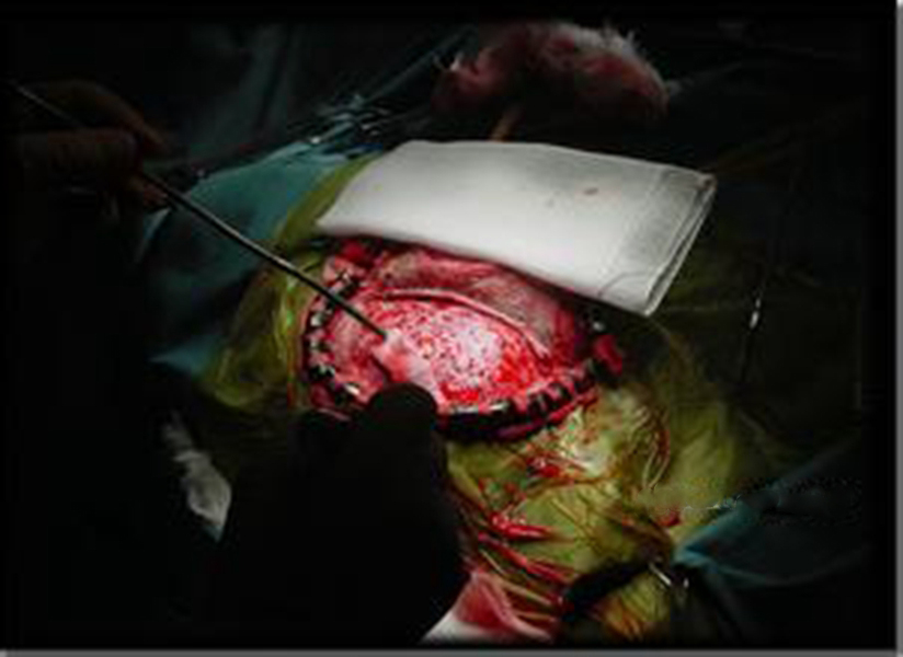 幼兒頭部手術煙霧病