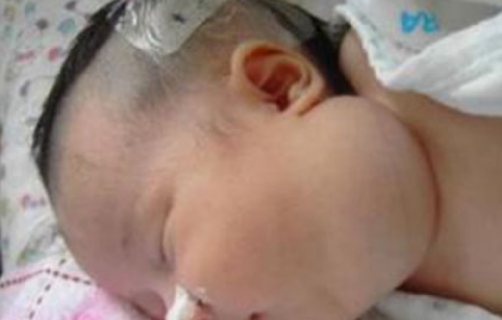 霍奇金氏淋巴瘤症狀 