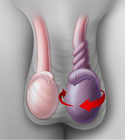 精索曲張睪丸下墜時