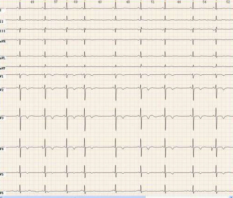 房顫心電圖特點 (40) 