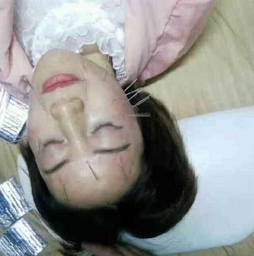 針灸治療腦血栓