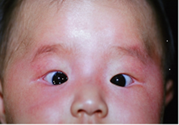 先天性青光眼寶寶