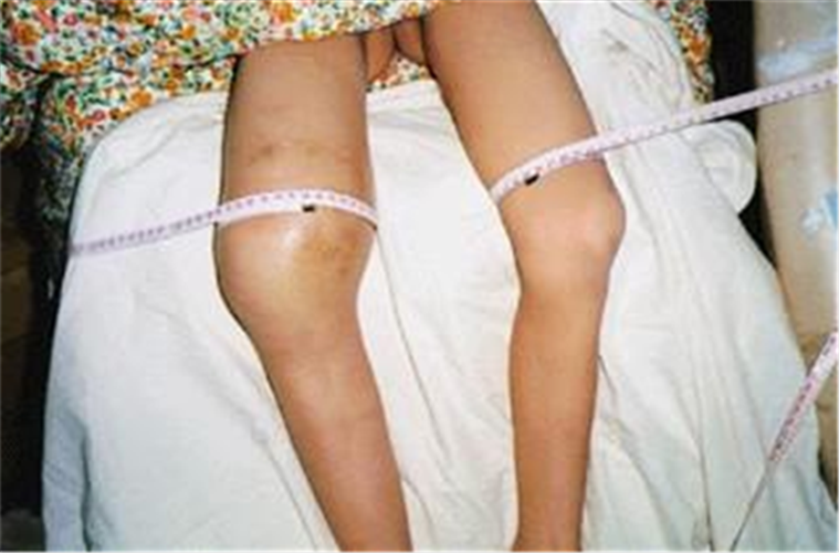 腿部女惡性骨腫瘤