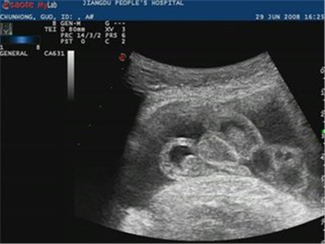 胎兒尿道下裂B超