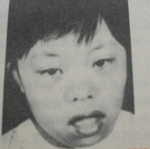 先天愚型三體綜合徵