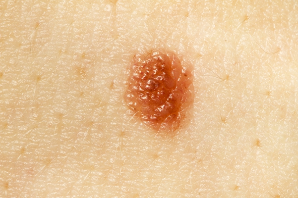 黑痣癌變的徵兆