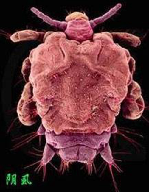 陰蝨病最佳治療方法的