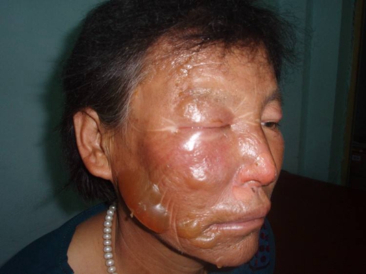 深二度燒傷 (52) 