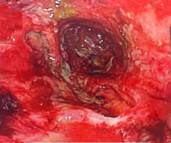 嚴重慢性結腸炎腐爛的