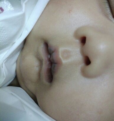 嬰兒嘴唇發紫 (42) 