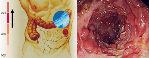 直腸息肉的黑斑