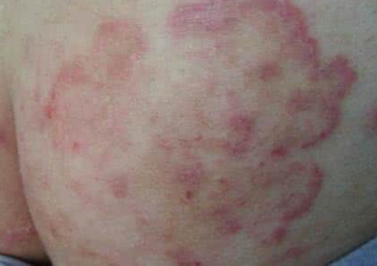 體股癬初期現象