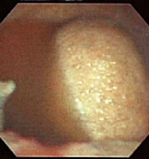 結核性胸膜炎症狀的