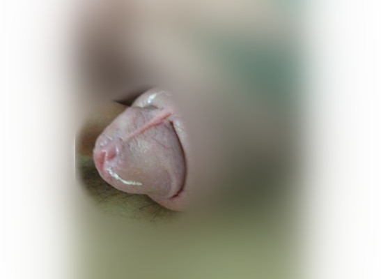 尿道口紅腫 (37) 