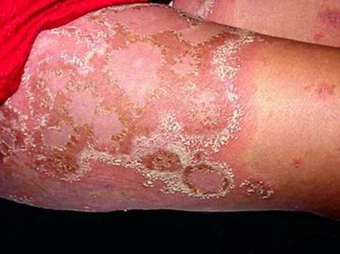 腿部大皰性皮膚病病