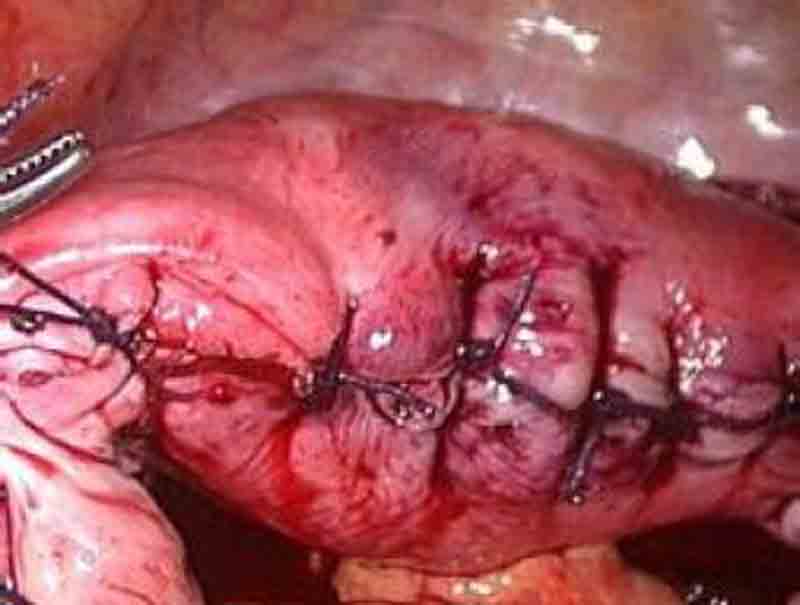 子宮肌瘤術後縫合