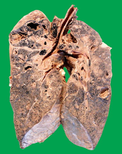 空洞型肺結核能活多久 (34) 