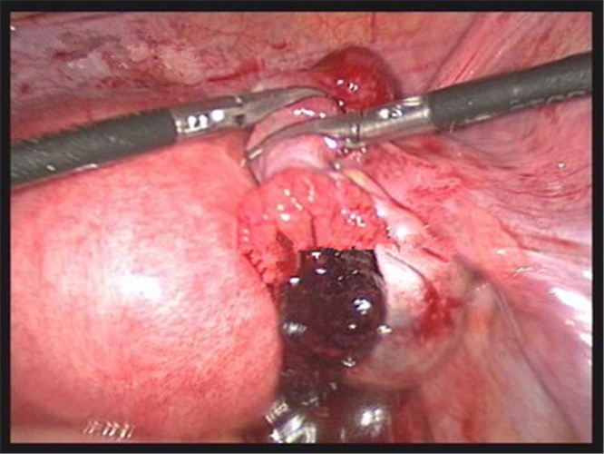 盆腔黏連導致宮外孕