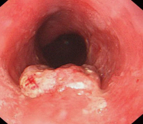 直腸癌晚期症狀 (7) 