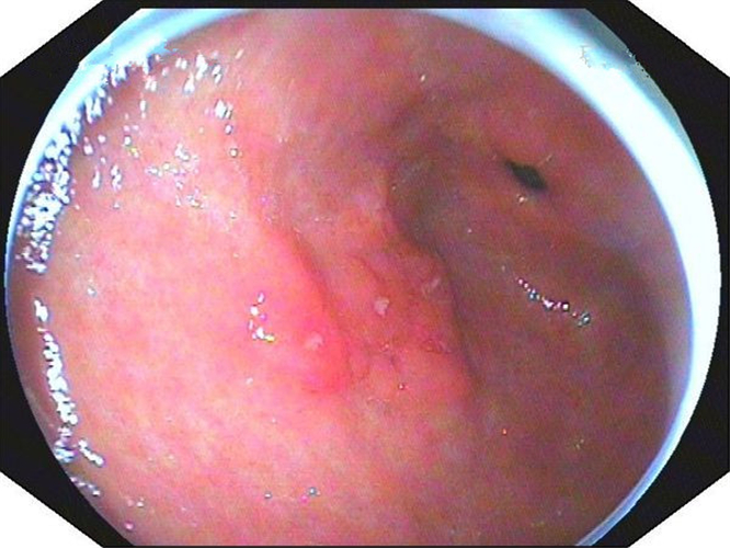 淺表型慢性胃炎發發