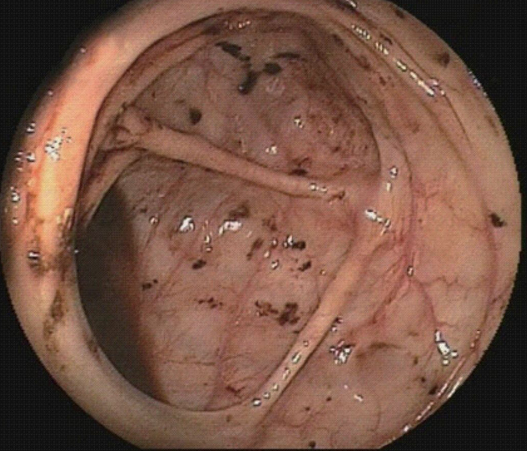 小腸克羅恩病鏡下