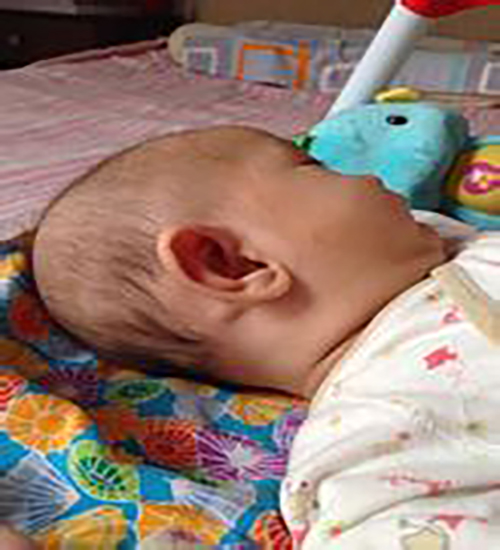 新生兒甲狀腺腫大症狀