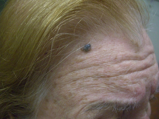 皮膚纖維瘤 (40) 