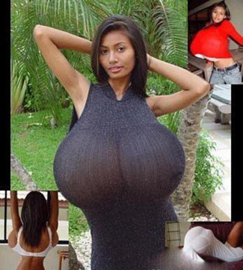 少女巨乳症示意