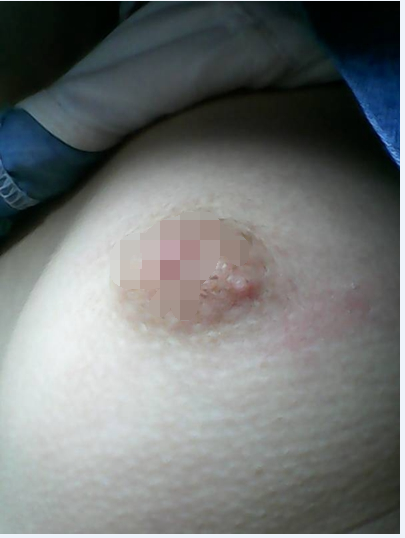乳房溼疹 (38) 