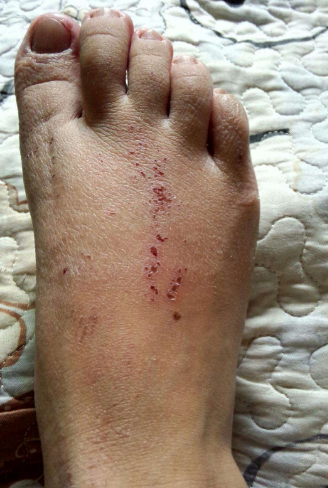 皮膚澱粉樣變 (49) 